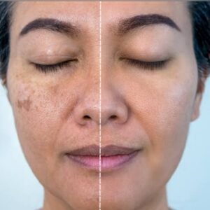 How to Remove Dark Spots & Pigmentation Fast