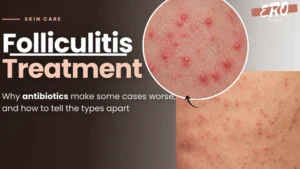 Folliculitis Treatment Why Antibiotics Make Some Cases Worse