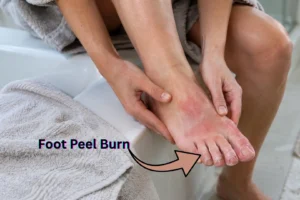 Foot Peel Burn Symptoms, Treatment and Prevention
