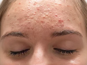 Fungal Acne Skincare Routine A Simple AM and PM Routine for Clearer Skin
